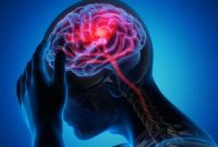 Kasus stroke kini semakin banyak menyerang usia muda akibat gaya hidup modern dan stres.