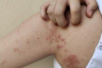 Ilustrasi kusta. (Foto: Getty Images/Rungrudee)