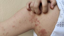 Ilustrasi kusta. (Foto: Getty Images/Rungrudee)