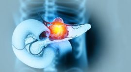 Ilustrasi kanker pankreas, penyakit serius yang sering terlambat terdeteksi karena gejalanya tidak spesifik.