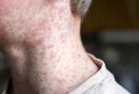 Ilustrasi: Indonesia termasuk negara dengan kasus campak tinggi. Seberapa mudah virus ini menular? (iStockphoto/Natalya Maisheva)